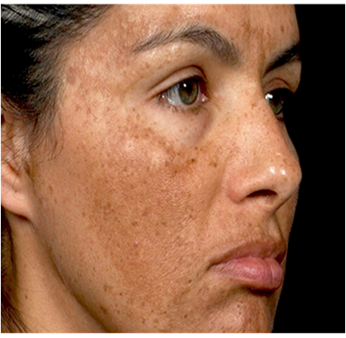 PIGMENTATION-2
